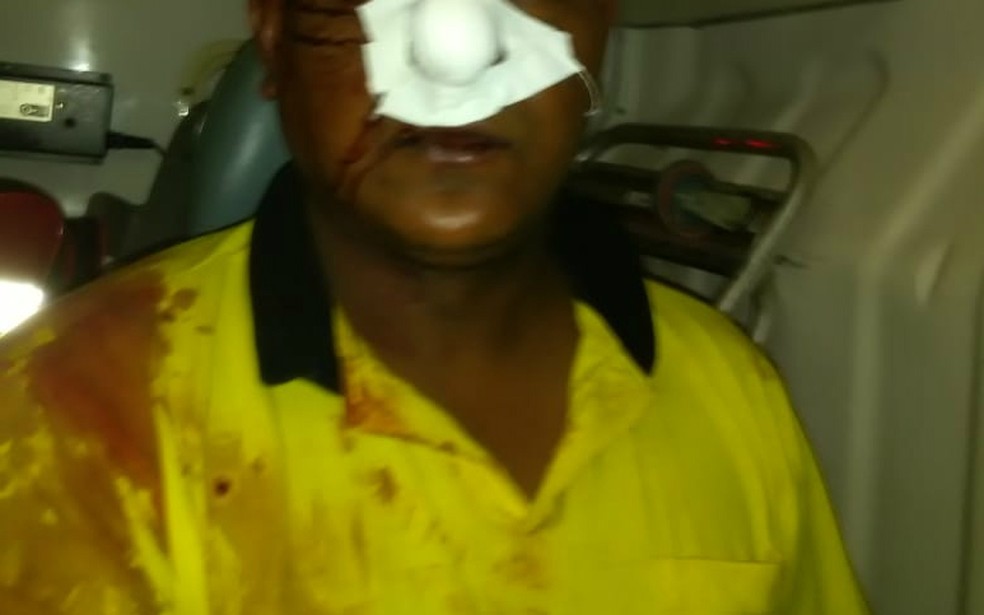 Passageiro arranca parte do nariz de taxista com mordida após confusão durante corrida