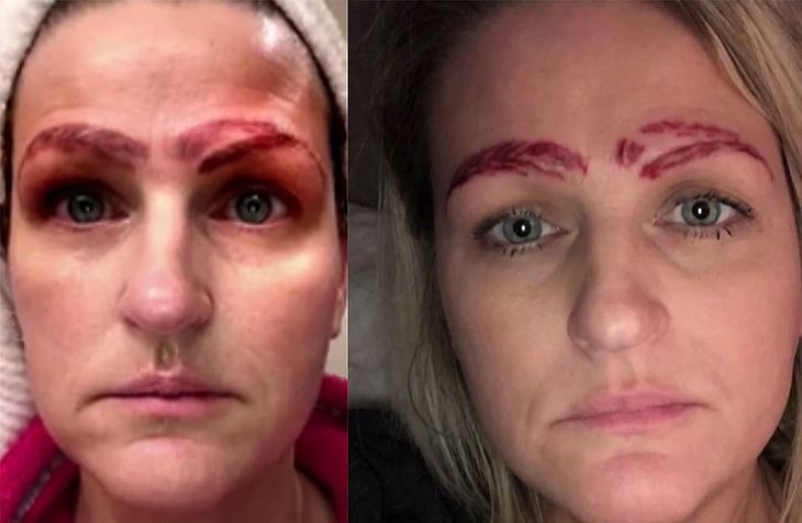 Microblading: Mulher fica com quatro ‘sobrancelhas’ após procedimento