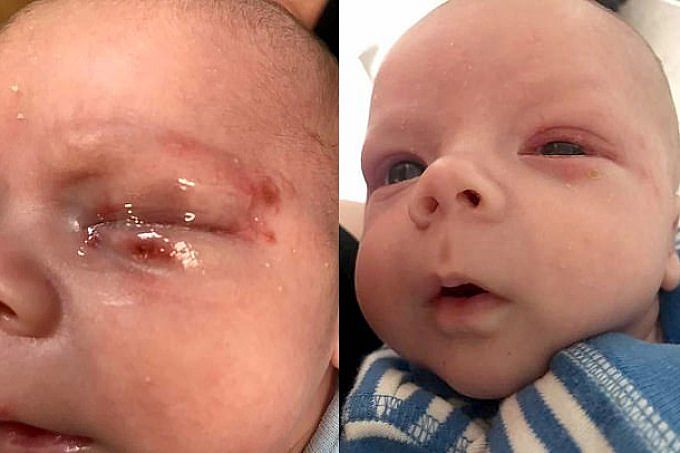 Bebê quase morre por herpes no olho contraída através de beijo