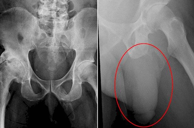 Raio-x descobre que pênis de idoso estava se transformando em osso no EUA