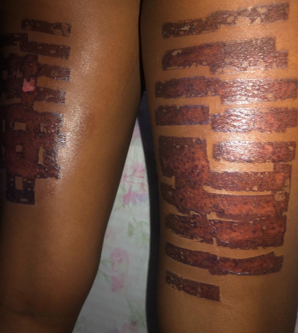 Modelo denuncia clínica por queimaduras de 2º grau durante procedimento estético em Maceió