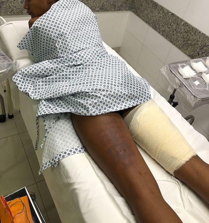 Clínica que fez depilação em modelo já foi denunciada pela Sociedade de Dermatologia