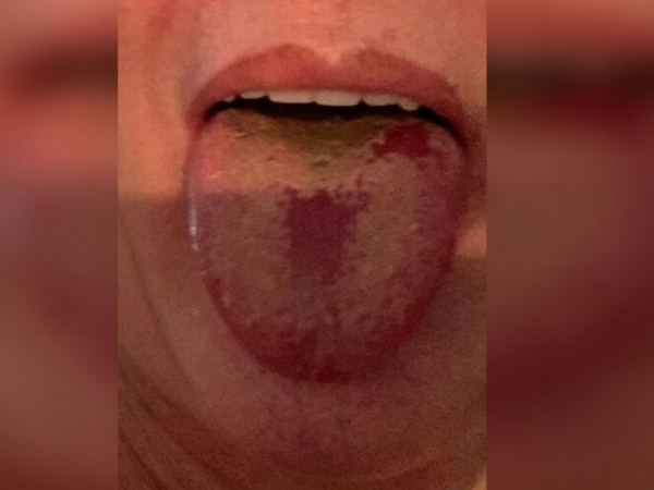 Especialista alerta para a ‘língua de covid’, um novo sintoma da doença