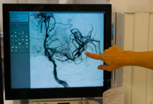 Coágulo sanguíneo: o que é o sintoma investigado como reação à vacina