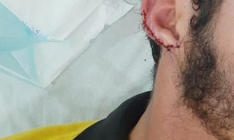 MP denuncia homem que arrancou pedaço de orelha de garçom em São José da Tapera