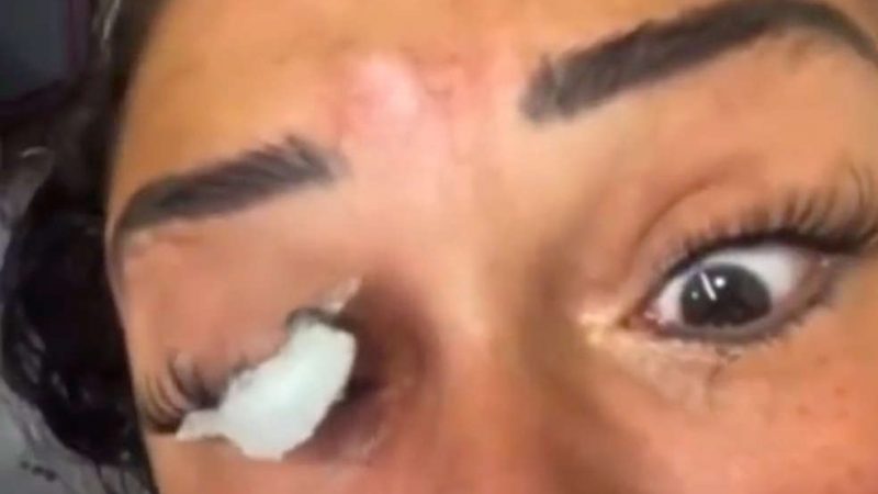 Empresária sofre queimaduras após esteticista utilizar cola Super Bonder para realizar extensão de cílios