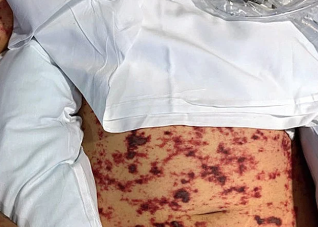 Jovem tem pernas amputadas após infecção por comida estragada