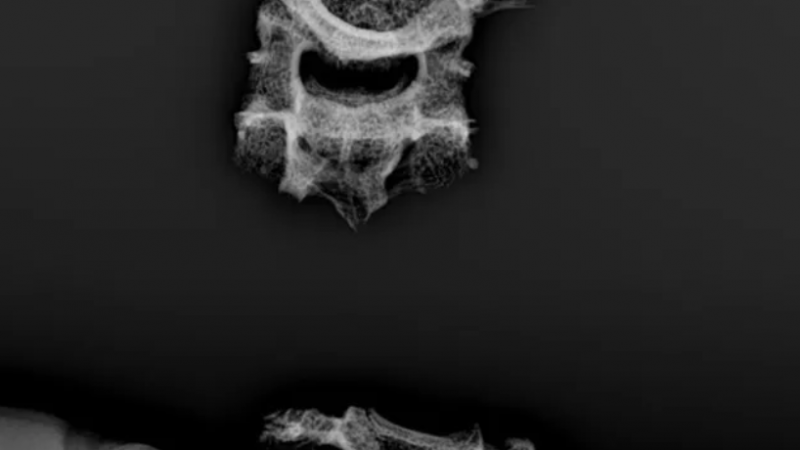 IML confirma que cabeça encontrada em Paripueira, AL, é de jovem decapitado em fevereiro