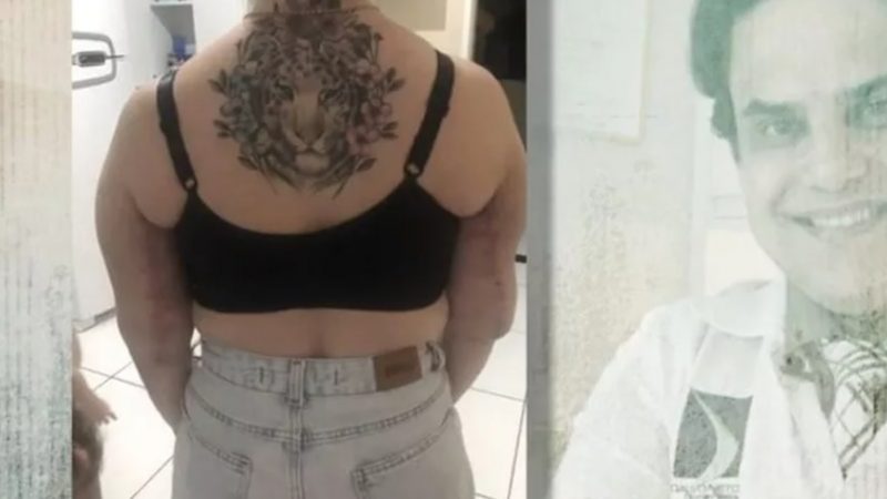 Mulheres que tiveram sequelas e complicações após cirurgias plásticas denunciam médico no Ceará