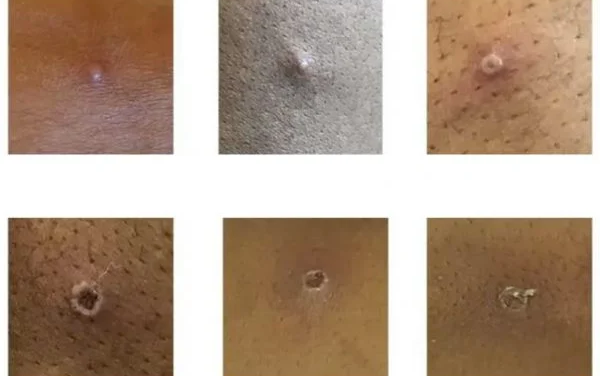 Ministério da Saúde confirma 106 casos de varíola dos macacos no país