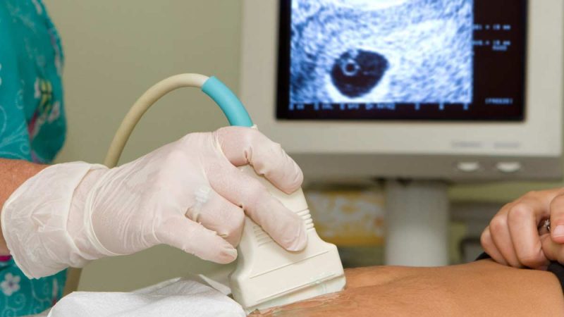 Homem passa 20 anos menstruando e descobre que tem útero e ovários