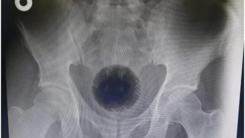 Homem passa por cirurgia para retirar bola de 7cm presa no ânus