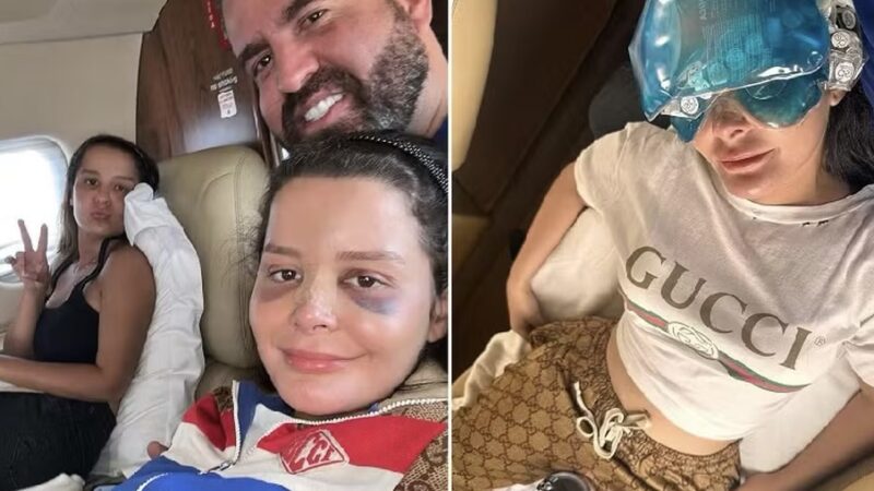 Maraísa posta foto de nariz quebrado e fala sobre acidente em piscina de resort em AL: ‘Era pra ser uma simples folga’
