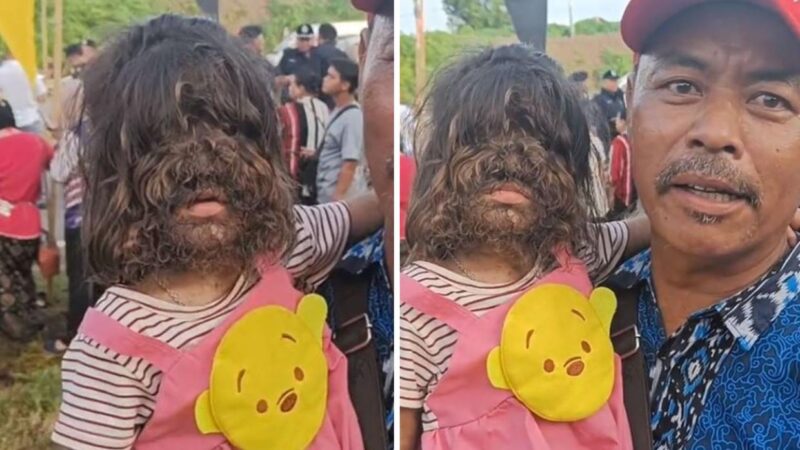 Menina com ‘síndrome do Lobisomem’ viraliza nas redes sociais; entenda condição rara