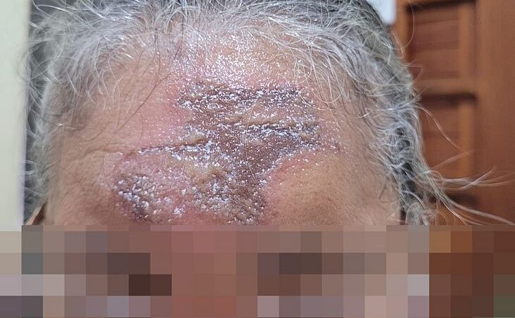 Fiéis sofrem lesões cutâneas após ungir-se com “òleo da graça” em igreja no Trapiche: Paróquia inicia investigação