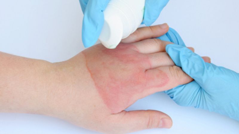 SMS orienta população a prevenir acidentes por queimadura