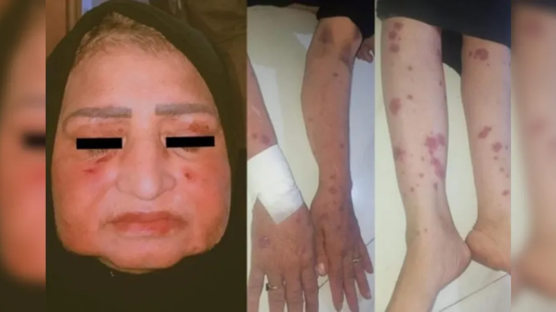 Mulher sofre alergia e chora lágrimas de pus após tomar ibuprofeno