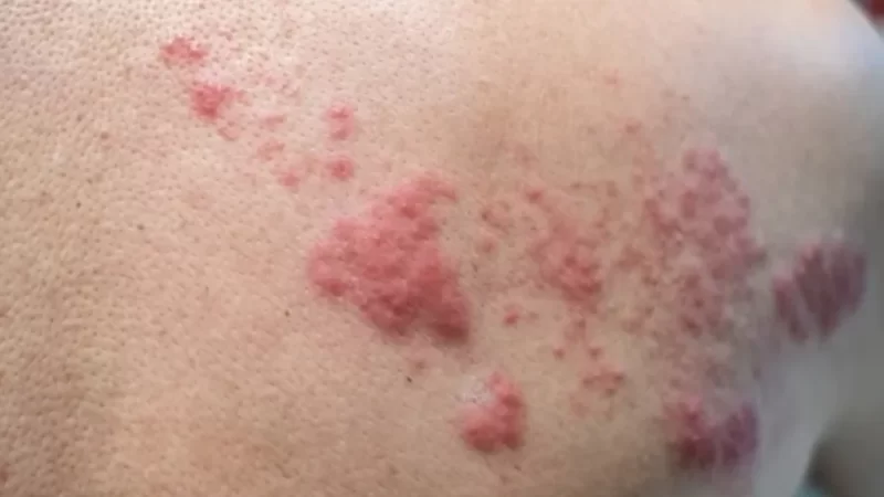 Herpes-zóster: diagnósticos da doença estão aumentando no Brasil