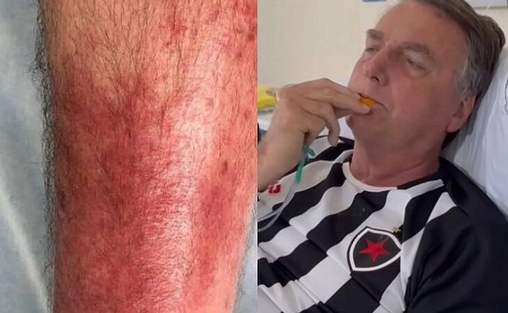 Saiba o que é erisipela, doença de pele que afeta o ex-presidente Jair Bolsonaro
