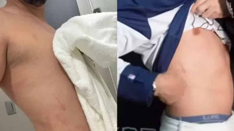 Nattan mostra machucados após se jogar no meio do público em show