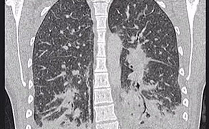 Cigarro eletrônico deixa jovem com pulmões parecidos com ‘vidros quebrados’; entenda