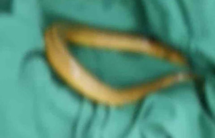 Homem quase morre após colocar enguia no ânus para tratar constipação