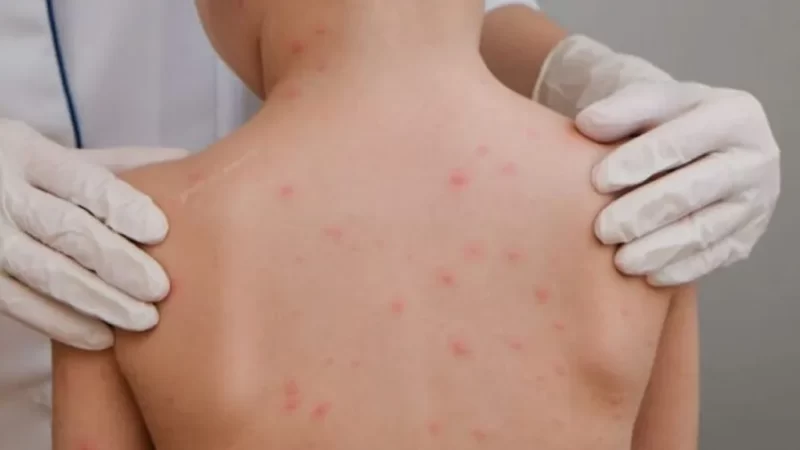 Alagoas já registrou 15 casos de meningite e 8 óbitos este ano