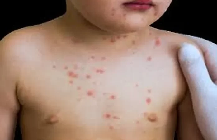 Meningite: infectologista esclarece dúvidas sobre a doença; taxa de letalidade em Alagoas atinge 72,7% em 2024