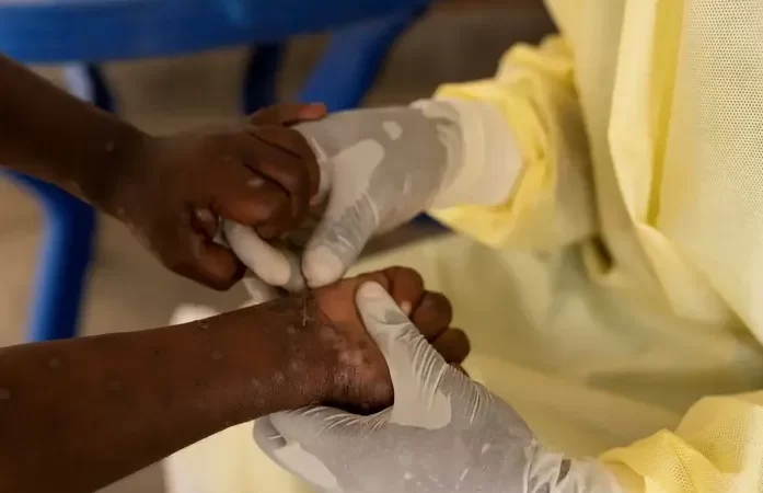 Vacina brasileira contra a mpox está próxima dos testes em humanos