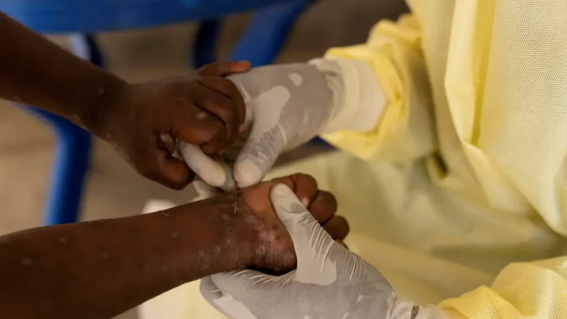 Casos de mpox no Brasil este ano já superam o total de 2023