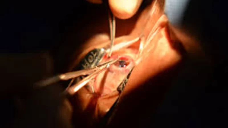 Número de transplantes de córnea cresce em Alagoas