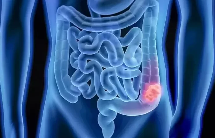 Câncer Colorretal: médica explica o procedimento e o pós-operatório da amputação do reto que a cantora Preta Gil realizou para tratar a doença