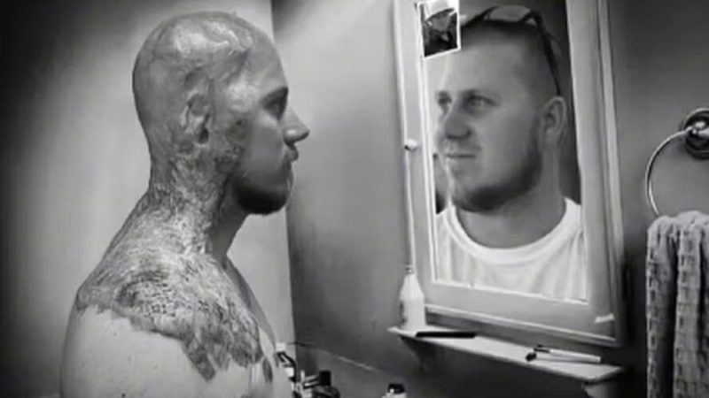 Homem sobrevive a choque de 4.160 volts na cabeça e desabafa sobre nova aparência