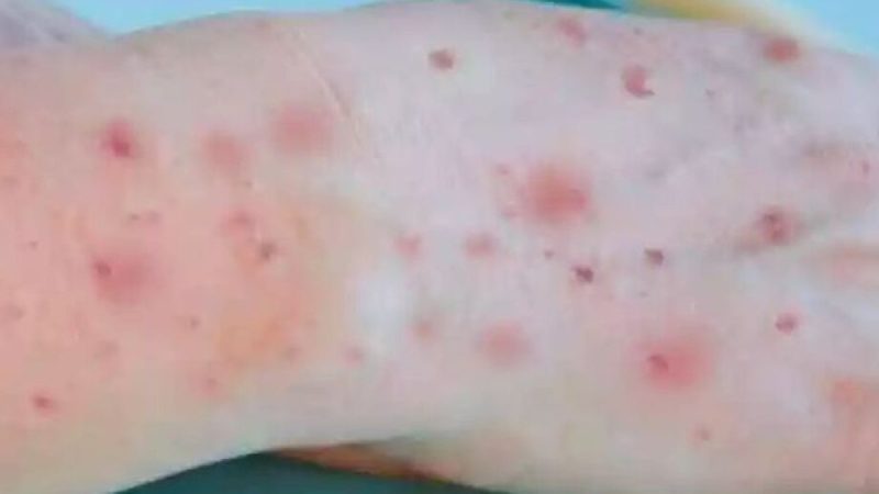 Mpox: OMS aprova primeira vacina para uso emergencial em crianças