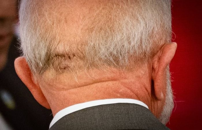 Presidente Lula tem hemorragia e faz cirurgia de emergência