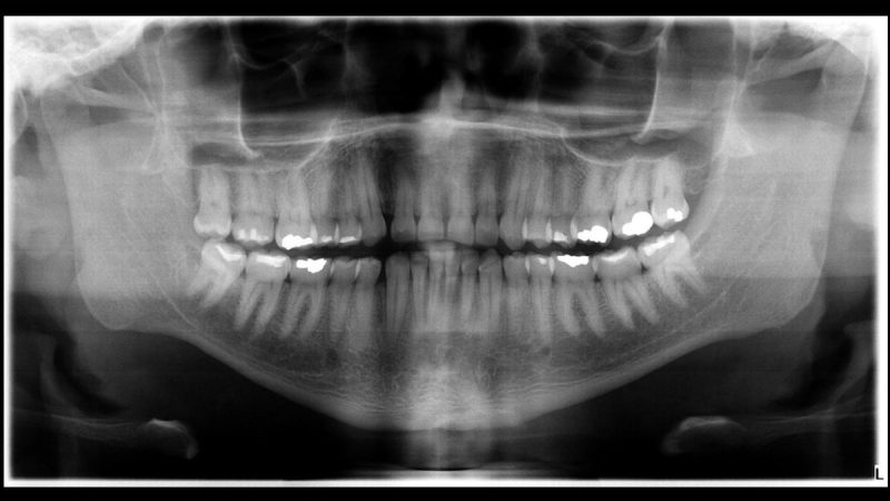 Corpo de enfermeiro do MT é identificado após exame de odontologia legal