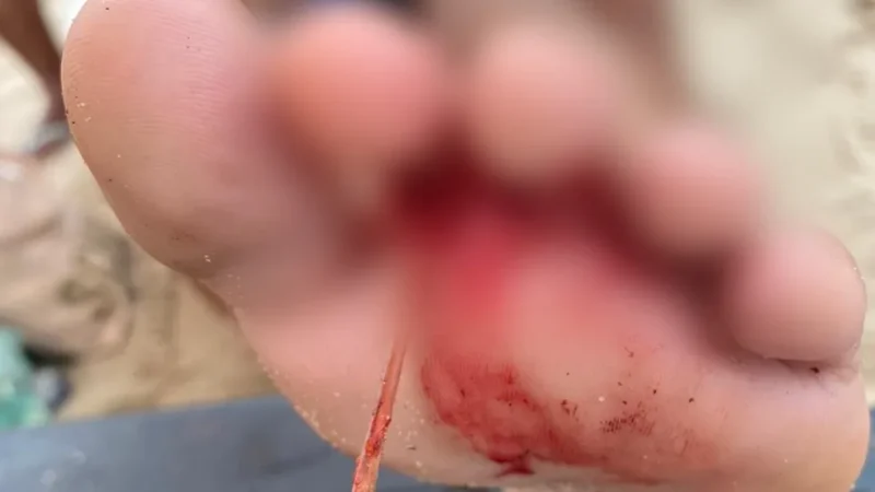 Adolescente sofre ferimento com ferrão de arraia na Praia do Francês, AL