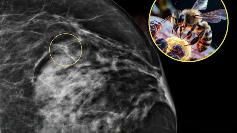 Veneno de abelha destrói células de câncer de mama agressivo em menos de uma hora, apontam pesquisadores