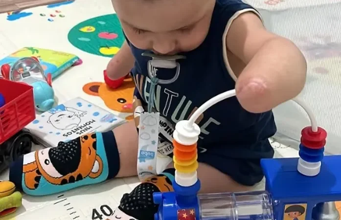 Bebê de Murici sobrevive a nove paradas cardíacas, passa por amputações e família pede ajuda para tratamento