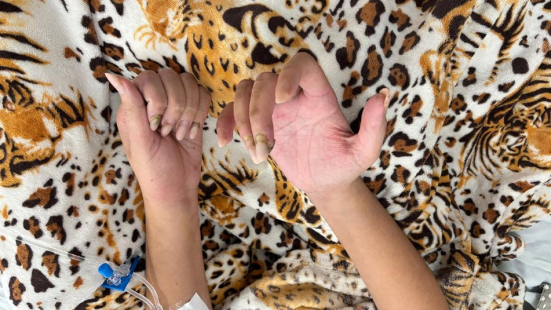 Após colocar unhas em gel, jovem é diagnosticada em hospital de AL com infecção rara e grave no coração