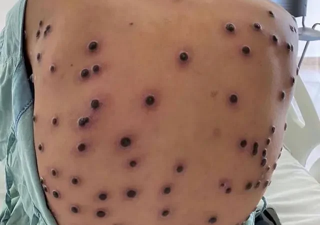 Brasil registra 88 casos confirmados de mpox e mantém monitoramento ativo, diz Ministério da