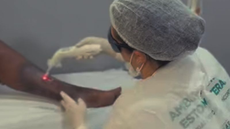 Programa Cicatriza Estrela amplia atendimento especializado e ultrapassa 2,8 mil procedimentos