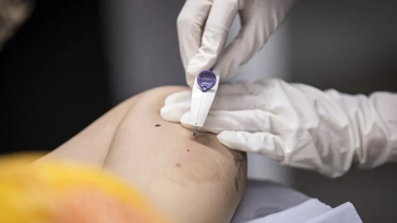 Implanon amplia acesso ao planejamento reprodutivo em Maceió